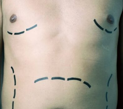How Can I Tell If I Have Gynecomastia or Just Chest Fat?